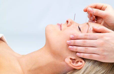 Beneficios de la acupuntura