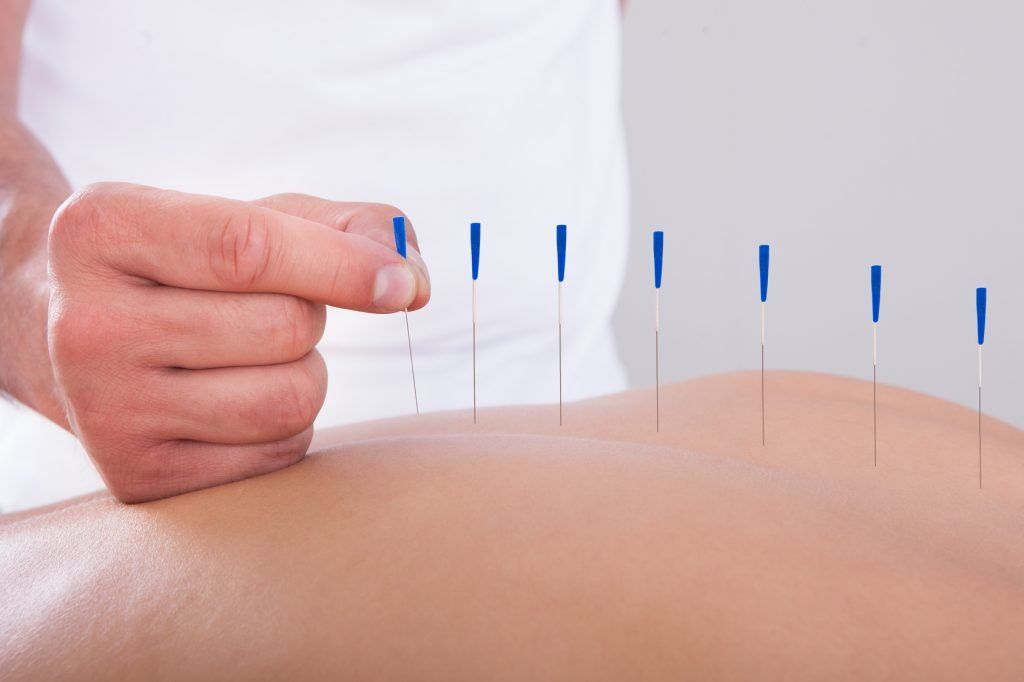 Tipos de acupuntura