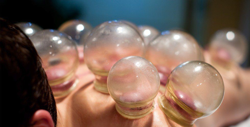 Beneficios de la ventosaterapia